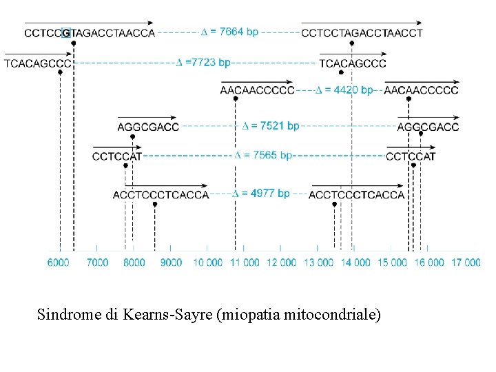 Sindrome di Kearns-Sayre (miopatia mitocondriale) 