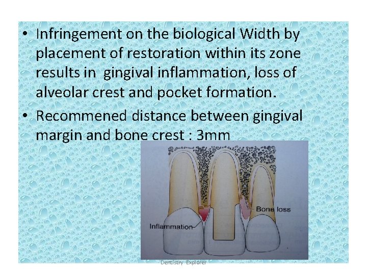  • Infringement on the biological Width by placement of restoration within its zone