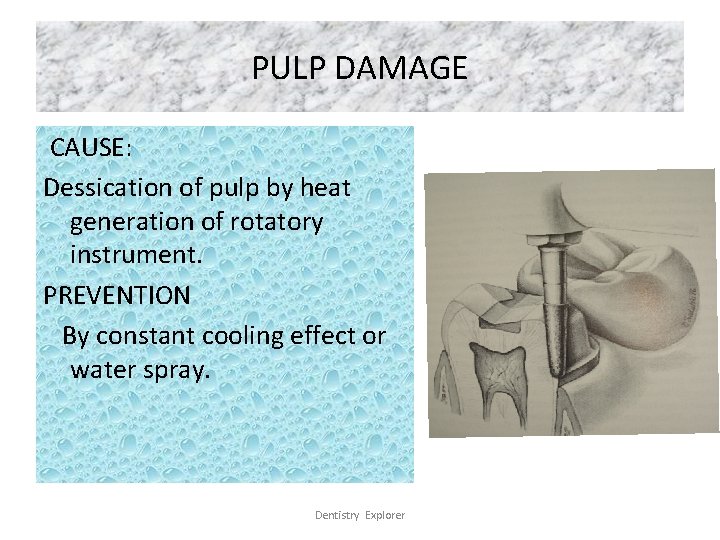 PULP DAMAGE CAUSE: Dessication of pulp by heat generation of rotatory instrument. PREVENTION By