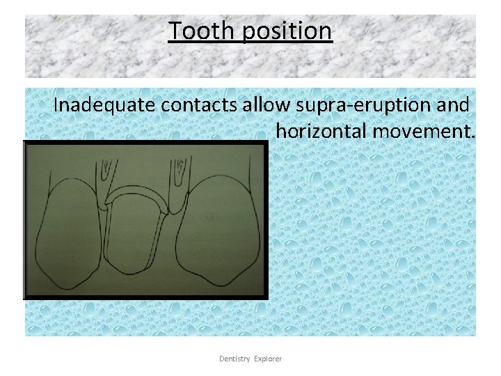 Tooth position Inadequate contacts allow supra-eruption and horizontal movement. Dentistry Explorer 
