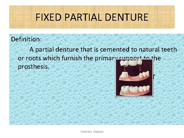 FIXED PARTIAL DENTURE Definition: A partial denture that is cemented to natural teeth or