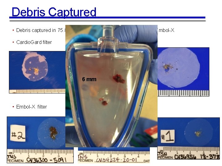 Debris Captured • Debris captured in 75. 8% of Cardio. Gard subjects and 99.