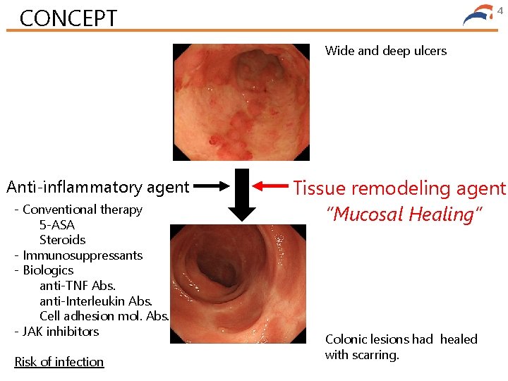 CONCEPT 4 Wide and deep ulcers Anti-inflammatory agent - Conventional therapy 5 -ASA Steroids