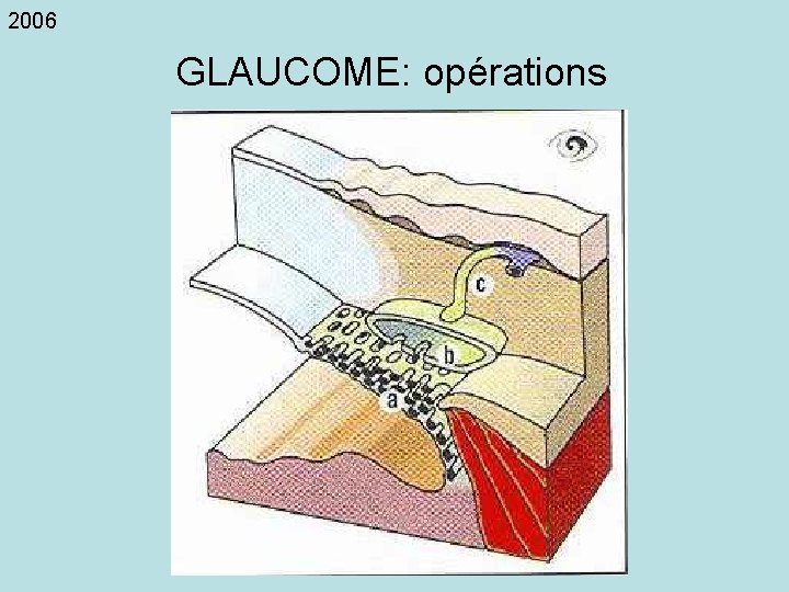 2006 GLAUCOME: opérations 