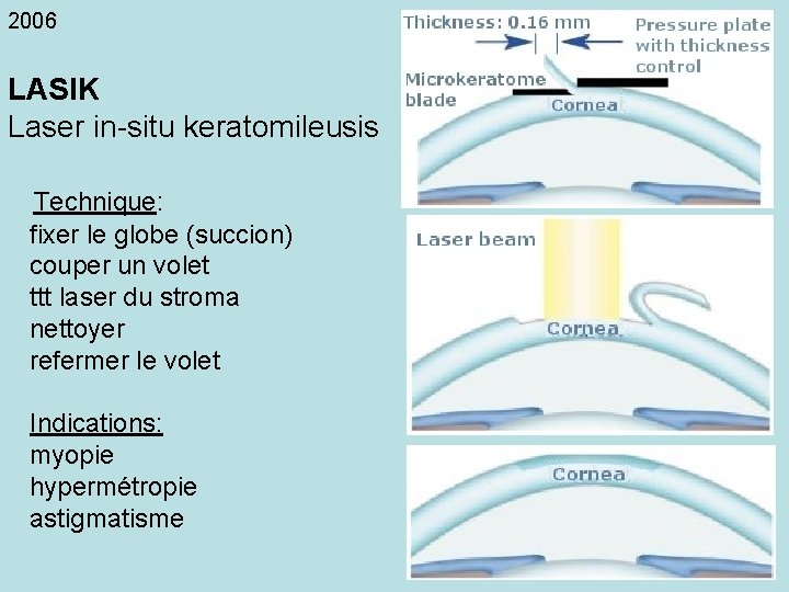 2006 LASIK Laser in-situ keratomileusis Technique: fixer le globe (succion) couper un volet ttt