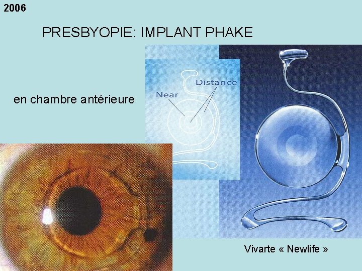 2006 PRESBYOPIE: IMPLANT PHAKE en chambre antérieure Vivarte « Newlife » 