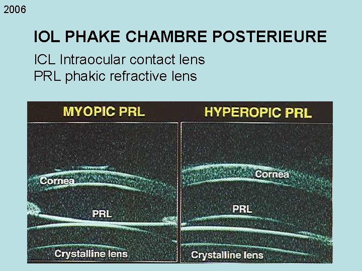 2006 IOL PHAKE CHAMBRE POSTERIEURE ICL Intraocular contact lens PRL phakic refractive lens 
