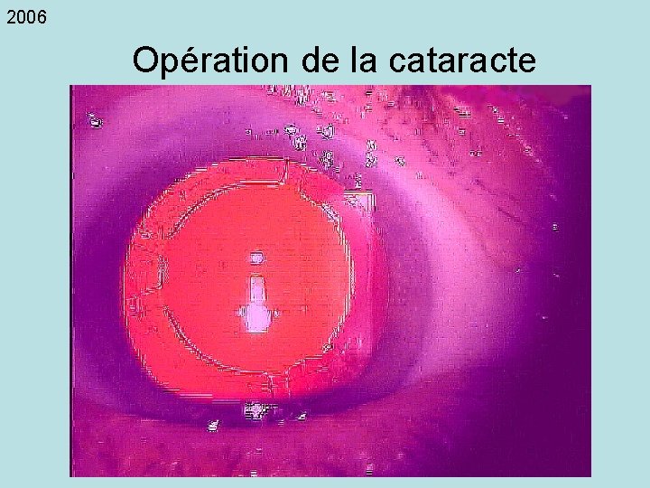 2006 Opération de la cataracte 