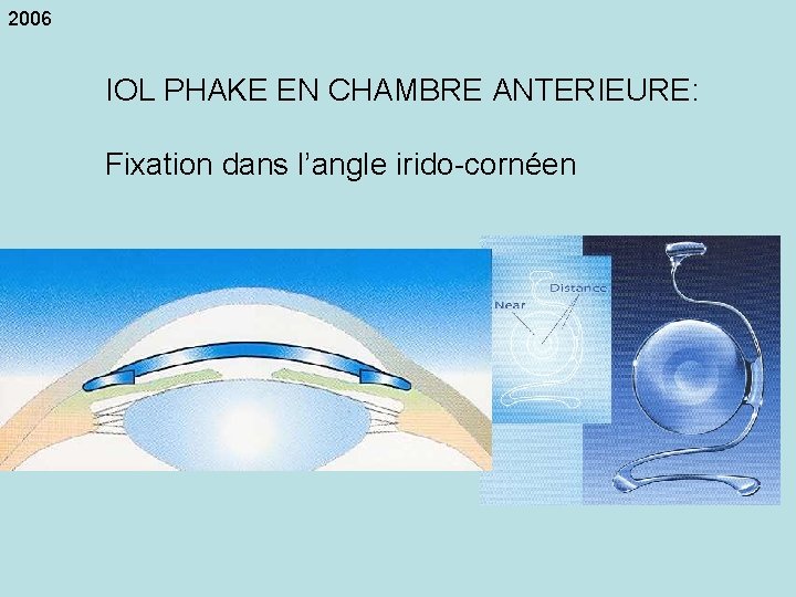2006 IOL PHAKE EN CHAMBRE ANTERIEURE: Fixation dans l’angle irido-cornéen 