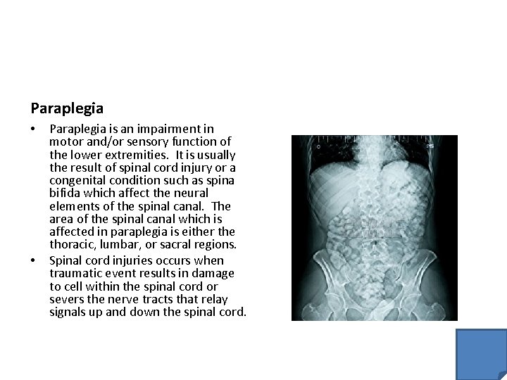 Paraplegia • • Paraplegia is an impairment in motor and/or sensory function of the
