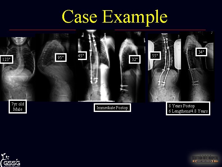 Case Example 95° 123° 7 yr old Male 45° 32° Immediate Postop 55° 34°