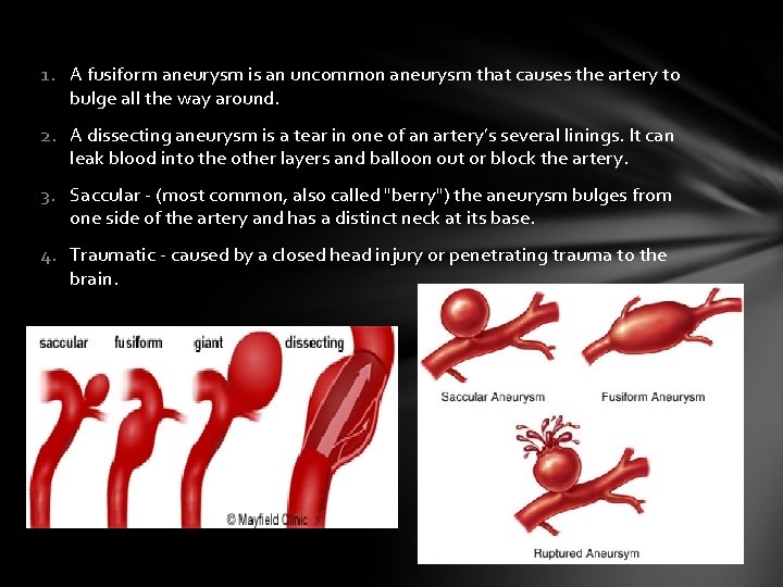 1. A fusiform aneurysm is an uncommon aneurysm that causes the artery to bulge