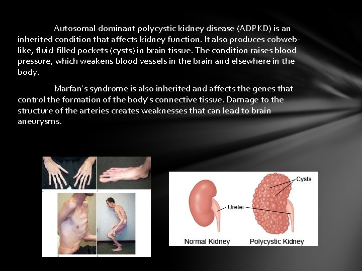 Autosomal dominant polycystic kidney disease (ADPKD) is an inherited condition that affects kidney function.