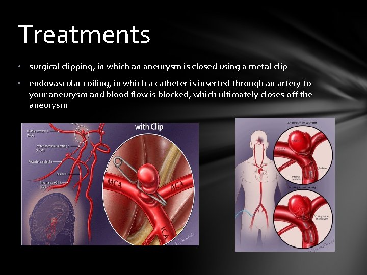 Treatments • surgical clipping, in which an aneurysm is closed using a metal clip