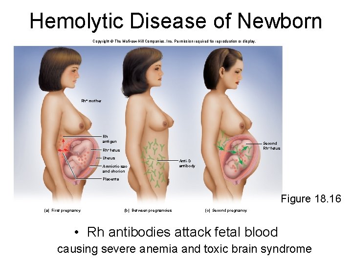 Hemolytic Disease of Newborn Copyright © The Mc. Graw-Hill Companies, Inc. Permission required for