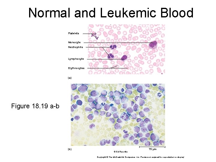 Normal and Leukemic Blood Platelets Monocyte Neutrophils Lymphocyte Erythrocytes (a) Figure 18. 19 a-b