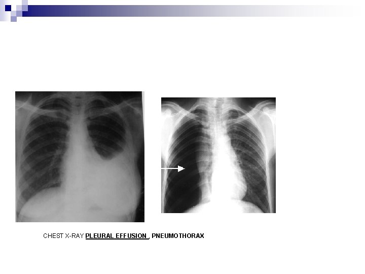 CHEST X-RAY PLEURAL EFFUSION , PNEUMOTHORAX 