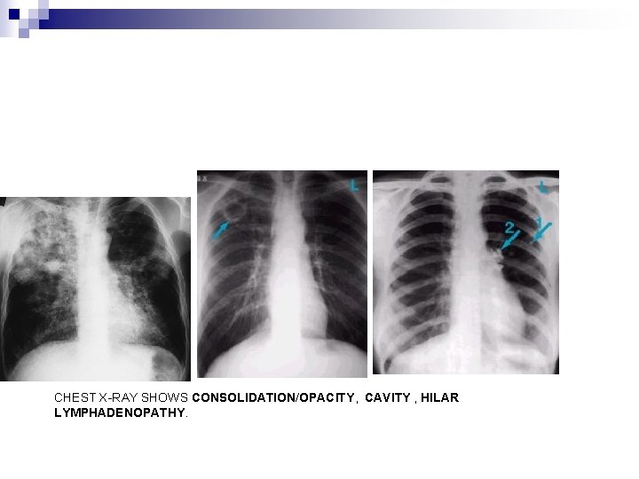 CHEST X-RAY SHOWS CONSOLIDATION/OPACITY, CAVITY , HILAR LYMPHADENOPATHY. 