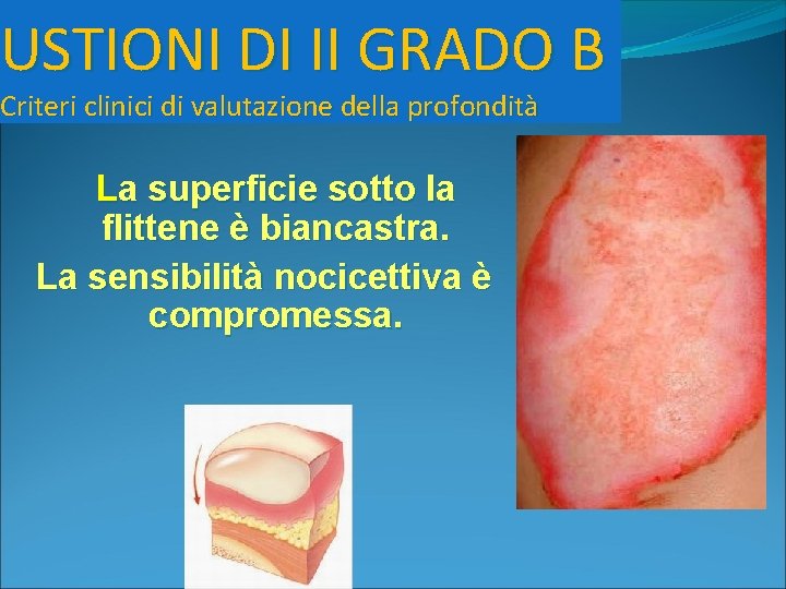 USTIONI DI II GRADO B Criteri clinici di valutazione della profondità La superficie sotto