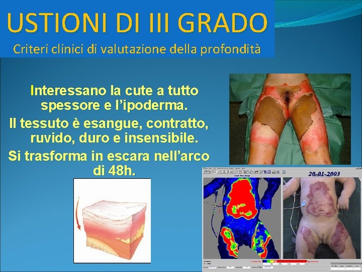 USTIONI DI III GRADO Criteri clinici di valutazione della profondità Interessano la cute a