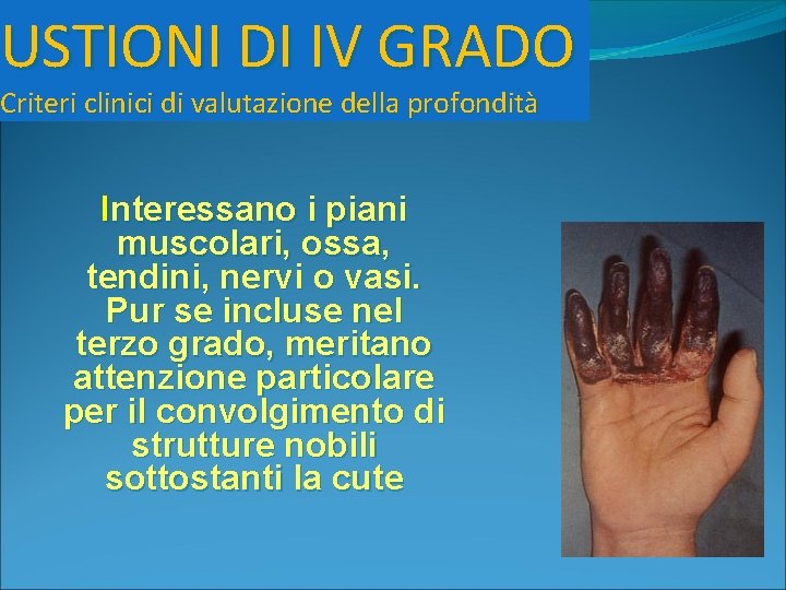 USTIONI DI IV GRADO Criteri clinici di valutazione della profondità Interessano i piani muscolari,