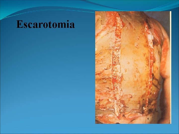 Escarotomia 