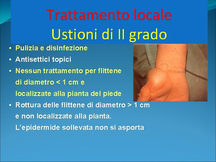 Trattamento locale Ustioni di II grado • Pulizia e disinfezione • Antisettici topici •