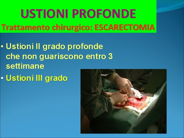 USTIONI PROFONDE Trattamento chirurgico: ESCARECTOMIA • Ustioni II grado profonde che non guariscono entro