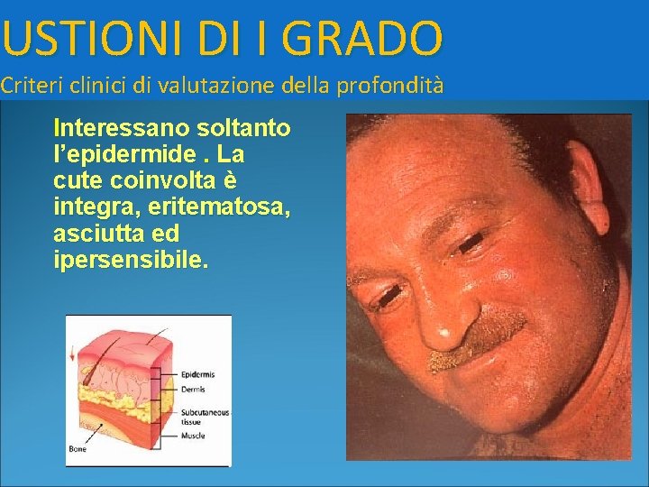 USTIONI DI I GRADO Criteri clinici di valutazione della profondità Interessano soltanto l’epidermide. La