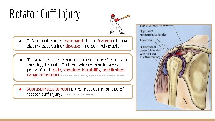 Rotator Cuff Injury ● Rotator cuff can be damaged due to trauma (during playing