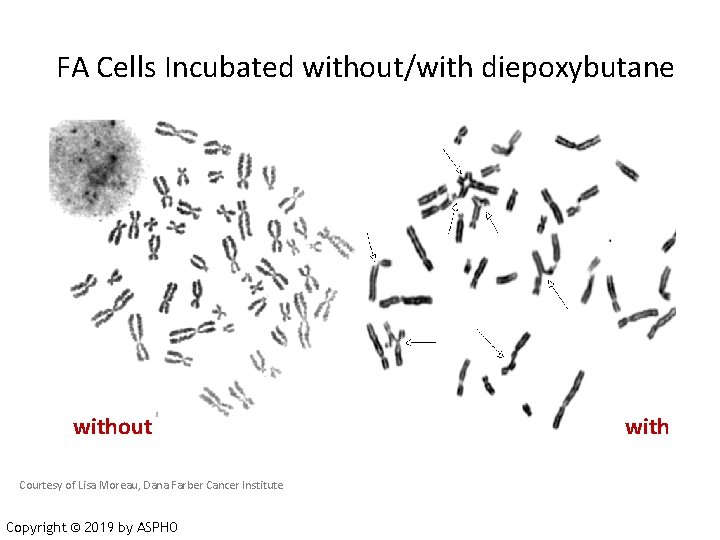 FA Cells Incubated without/with diepoxybutane without Courtesy of Lisa Moreau, Dana Farber Cancer Institute
