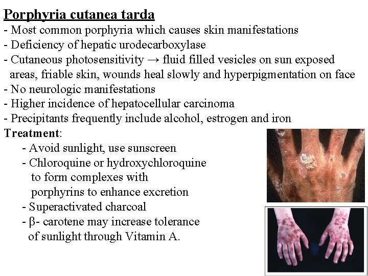 Porphyria cutanea tarda - Most common porphyria which causes skin manifestations - Deficiency of