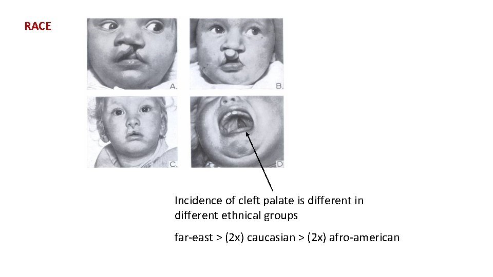 RACE Incidence of cleft palate is different in different ethnical groups far-east > (2