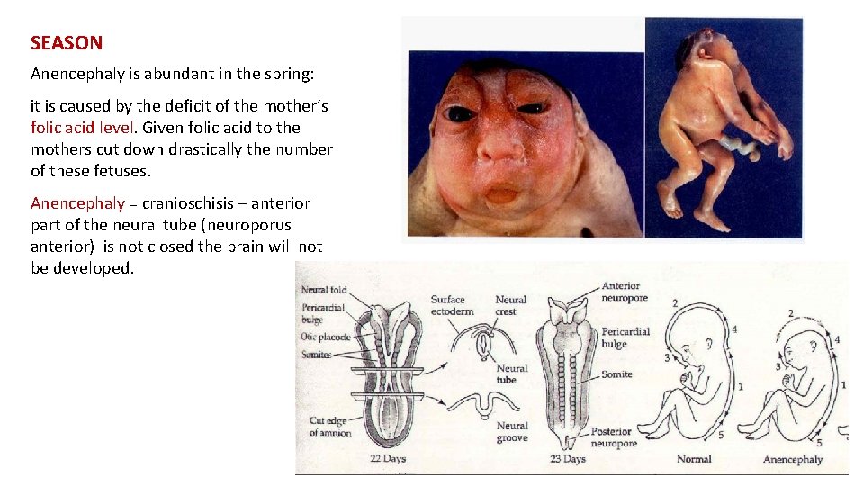 SEASON Anencephaly is abundant in the spring: it is caused by the deficit of