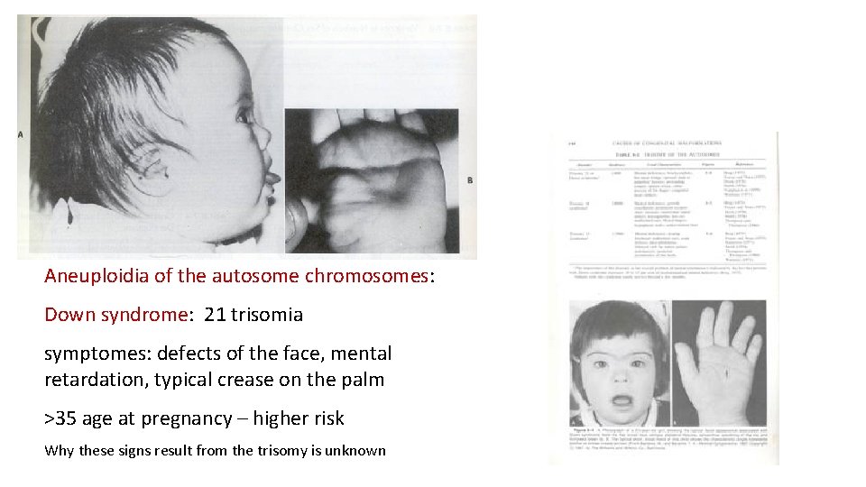 Aneuploidia of the autosome chromosomes: Down syndrome: 21 trisomia symptomes: defects of the face,