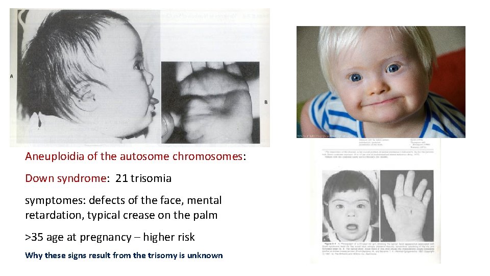 Aneuploidia of the autosome chromosomes: Down syndrome: 21 trisomia symptomes: defects of the face,