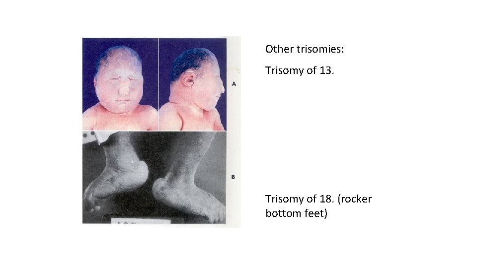 Other trisomies: Trisomy of 13. Trisomy of 18. (rocker bottom feet) 