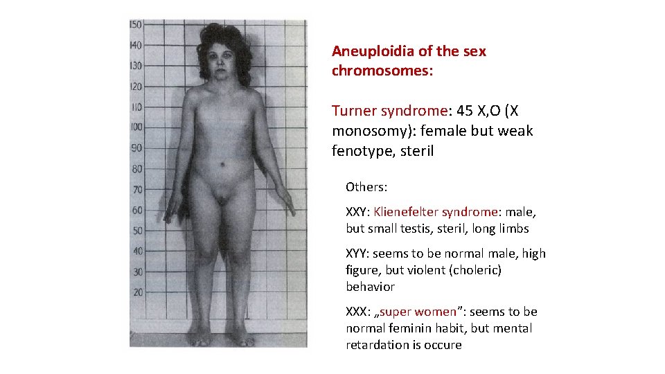 Aneuploidia of the sex chromosomes: Turner syndrome: 45 X, O (X monosomy): female but