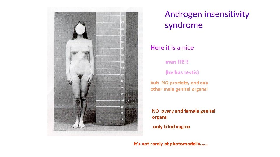 Androgen insensitivity syndrome Here it is a nice man !!!!!! (he has testis) but: