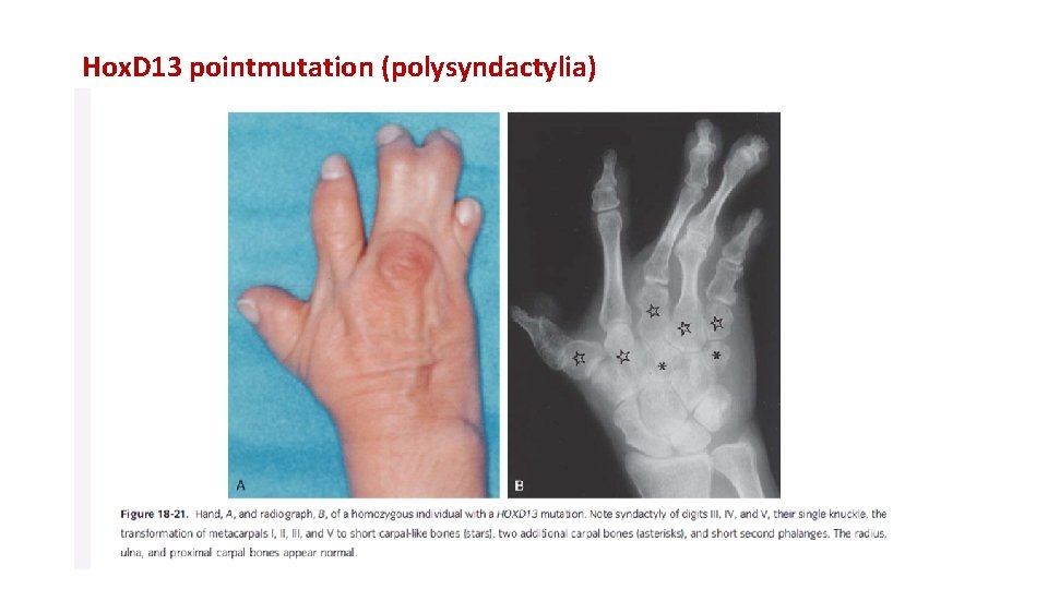 Hox. D 13 pointmutation (polysyndactylia) Syndaktilia: az ujjak összeolvadása. Ebben a humán esetben a
