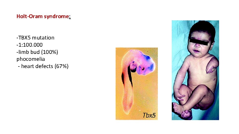 Holt-Oram syndrome: -TBX 5 mutation -1: 100. 000 -limb bud (100%) phocomelia - heart