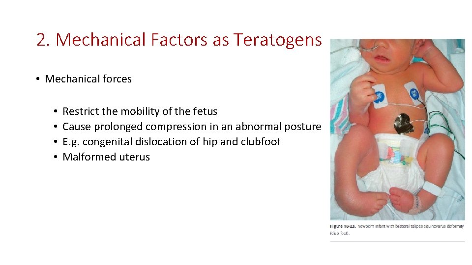 2. Mechanical Factors as Teratogens • Mechanical forces • • Restrict the mobility of