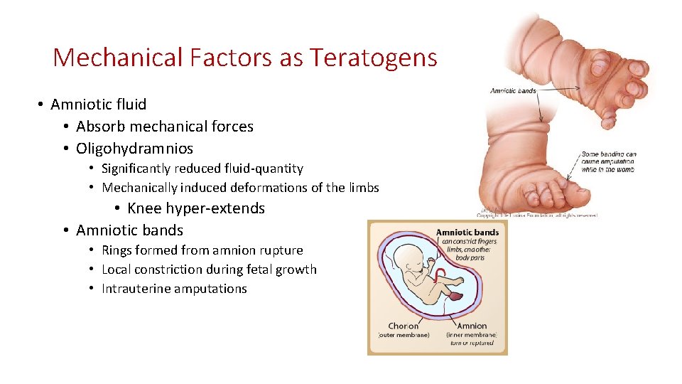 Mechanical Factors as Teratogens • Amniotic fluid • Absorb mechanical forces • Oligohydramnios •