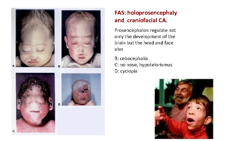 FAS: holoprosencephaly and craniofacial CA. Prosencephalon regulate not only the development of the brain
