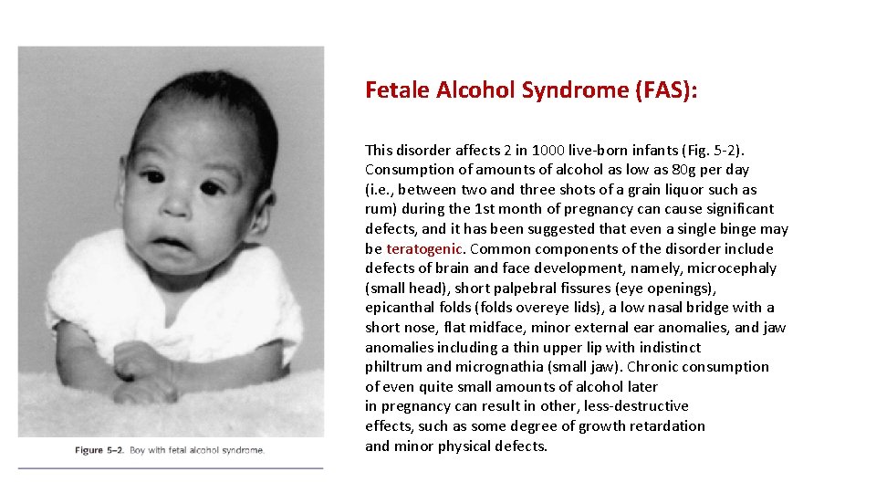 Fetale Alcohol Syndrome (FAS): This disorder affects 2 in 1000 live-born infants (Fig. 5