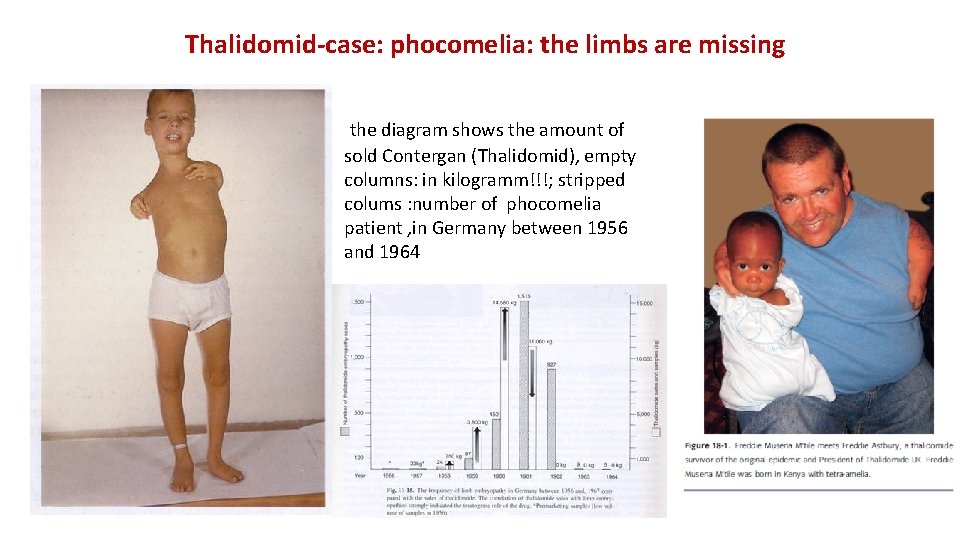 Thalidomid-case: phocomelia: the limbs are missing the diagram shows the amount of sold Contergan