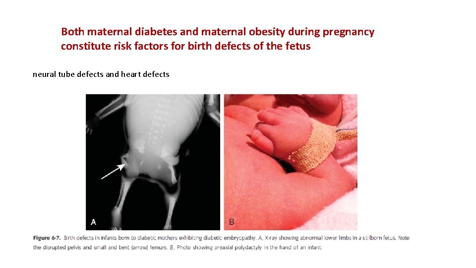 Both maternal diabetes and maternal obesity during pregnancy constitute risk factors for birth defects