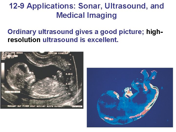 12 -9 Applications: Sonar, Ultrasound, and Medical Imaging Ordinary ultrasound gives a good picture;