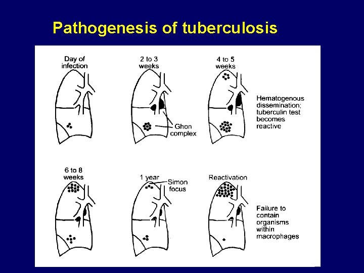 Pathogenesis of tuberculosis 