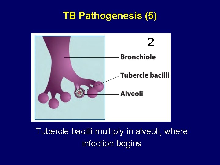 TB Pathogenesis (5) 2 Tubercle bacilli multiply in alveoli, where infection begins 